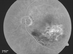 Fluoreszenzangiographie eines venösen Augeninfarktes