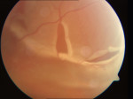 Netzhautablösung (Amotio retinae)
